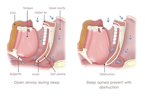Sleep Apnea Surgery Penn Medicine