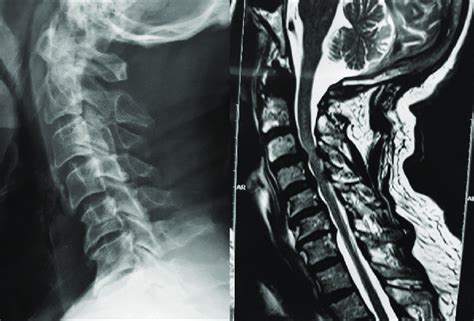 C4 Disc Herniation Symptoms