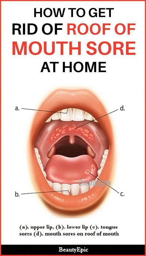 How To Get Rid Of Roof Of Mouth Sore At Home Healthcaretips Whatisoralbgumcaremode Mouth