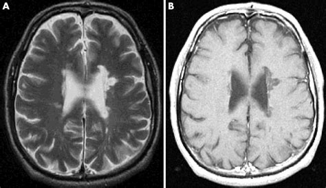 Imaging In Multiple Sclerosis Journal Of Neurology Neurosurgery