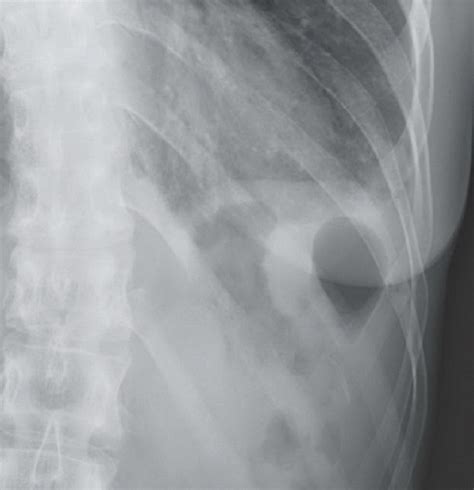 Rib Fracture With Hemopneumothorax Radiology Key