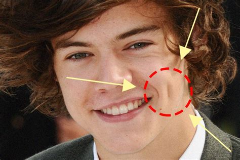 Millennials Are Heading To The Plastic Surgeon For Harry Styles Esque Dimples