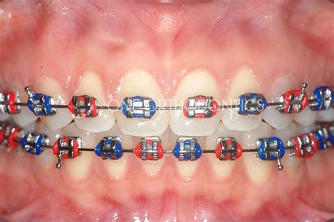 Good Christmas Colors For Braces Warehouse Of Ideas