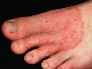 Tinea Pedis Fungal Foot Infection Dermnet