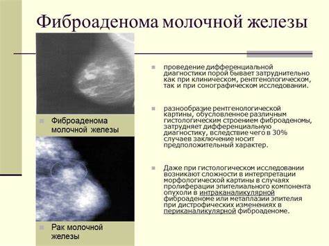 Фиброаденома молочной железы диета Фиброаденома Молочной Железы Операция Фото – Telegraph Фиброаденома Молочной Железы Операция Фото – Telegraph Фиброаденома молочной железы диета