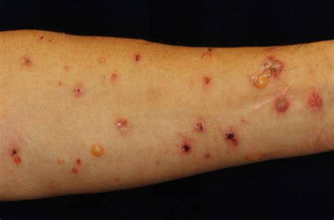 A Risk Factor For Drug Induced Skin Disease Identified Asia Research News