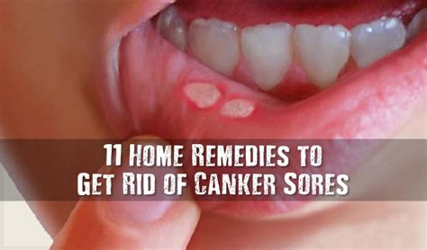 11 Home Remedies To Get Rid Of Canker Sores Best Herbal Health