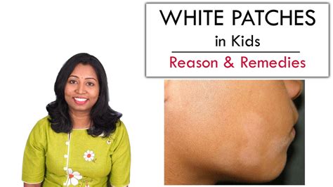 White Patches In Kids Face Reason Care And Remedy Youtube