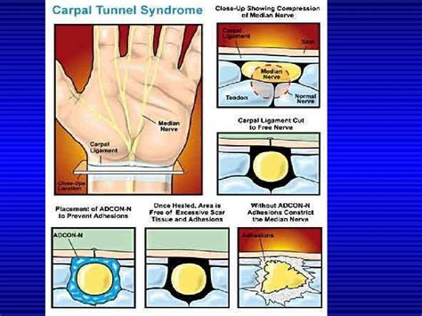 Carpal Tunnel Syndromeppt