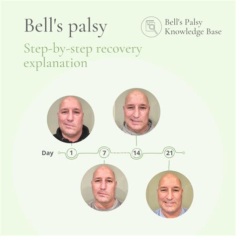 Bell S Palsy Knowledge Base Crystal Touch Bell S Palsy Clinic