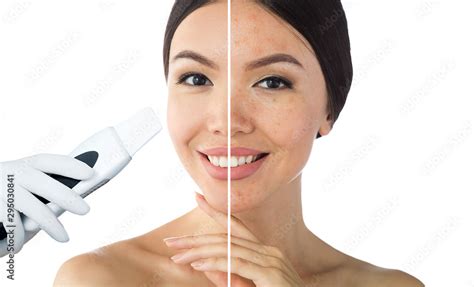 Comparison Face Of Beautiful Woman With Problem Acneblackhead And
