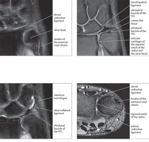 Tfcc Anatomy : Clinical Anatomy Operative Surgery Facebook / A tfcc
