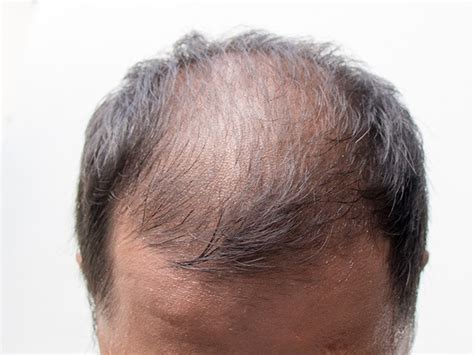 At What Age Do Most Men With Male Pattern Baldness Start Balding Quora