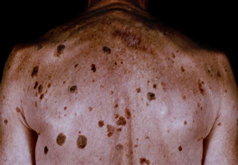 Dermatosis Papulosa Nigra Treatment And Management Approach Considerations