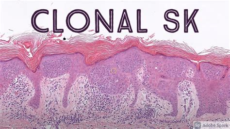 Clonal Seborrheic Keratosis Potential Mimic Of Squamous Cell Carcinoma