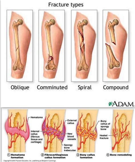 To learn more about the human skeletal system and how to keep your bones healthy, visit the links on the next page. Fracture types and Stages of healing: All fractures can be ...