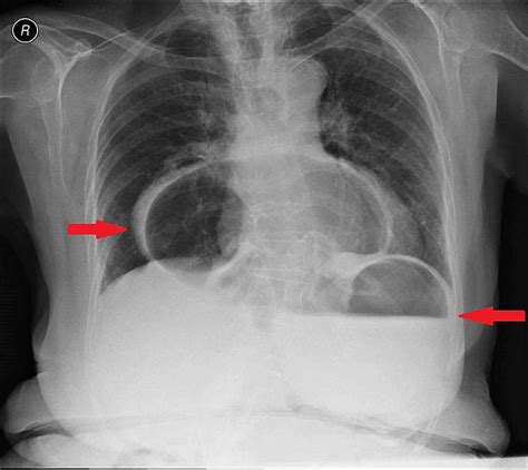 Hiatal Hernia On Chest X Ray Hot Sex Picture