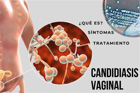 ᐉ candidiasis vaginal ¿qué es síntomas tratamiento