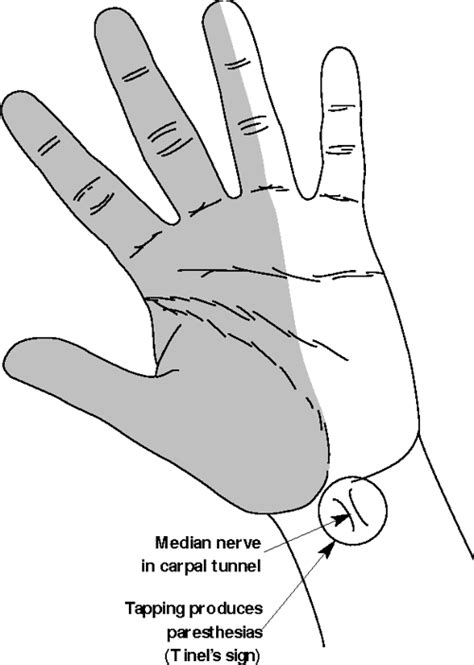 Tinels Sign And Phalens Maneuver Physical Signs Of Carpal Tunnel Syndrome Semantic Scholar