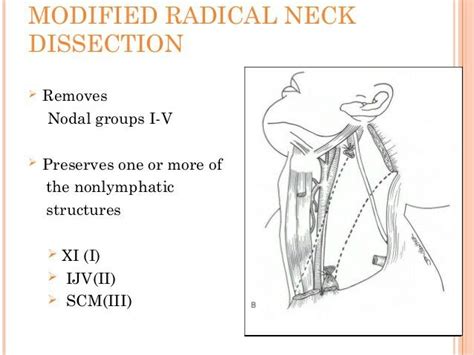 Neck Lymph Node Dissection01 【 Note In Modified Radical Neck