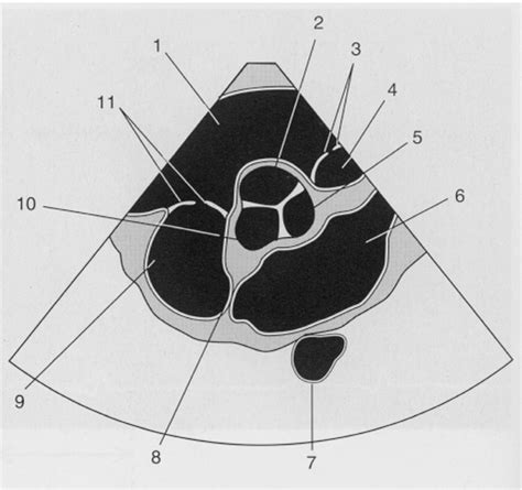 Parasternal Short Axis Aortic Valve Level Pt12 Diagram Quizlet