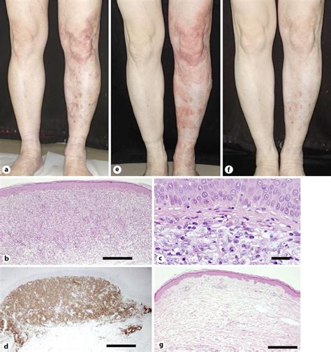 Figure 1 From Transient Wheal Attack Corresponding To The Tumor Lesions