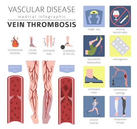 Deep Venous Thrombosis Dvt Symptoms Diagnosis Treatment And