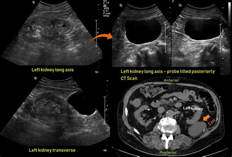 Ultrasound Features Of Kidney Cysts Renal Fellow Network