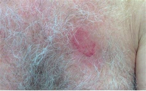 Derm Dx A Farmers Rash That Worsened With Topical Corticosteroid