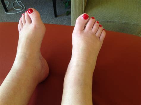 Foot And Ankle Swelling Change After 30 Minutes Of Treating The