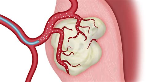 Uterine Fibroid Embolization An Effective Alternative To Hysterectomy