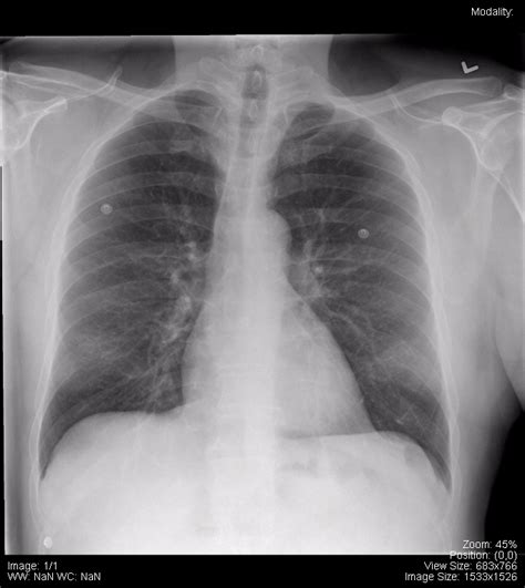 Let them drink up some contrast it's even more awesome! Chest - Undergraduate Diagnostic Imaging Fundamentals