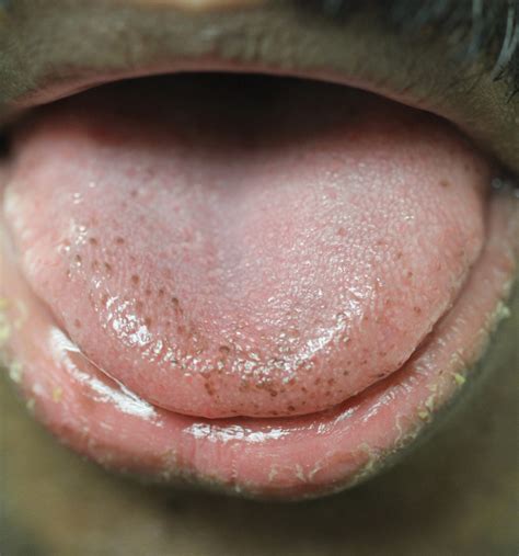 Pigmented Fungiform Papillae Of The Tongue In An Indian Male MDedge