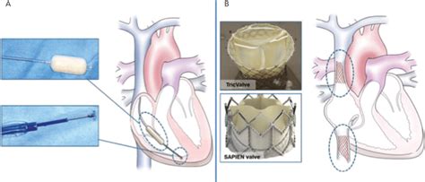 Transcatheter Tricuspid Valve Repair Devices A Caval Implant And B