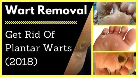 Wart Removal How To Get Rid Of Plantar Warts 2018 Youtube
