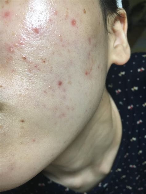 Little Tiny Bumps On My Cheeks Rosacea Type2 Perioral Dermatitis