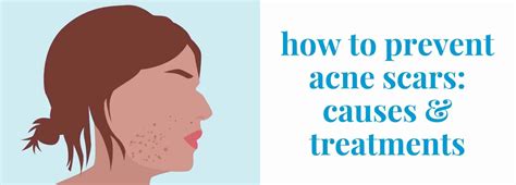 How To Prevent Acne Scars Causes And Treatments Pandia Health
