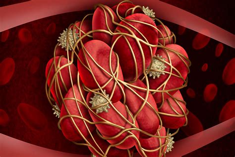 Clot Busting Drugs Not Recommended For Most Patients With Blood Clots