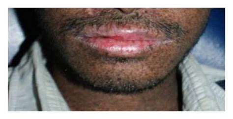Actinic Cheilitis Of Upper And Lower Lips Download Scientific Diagram