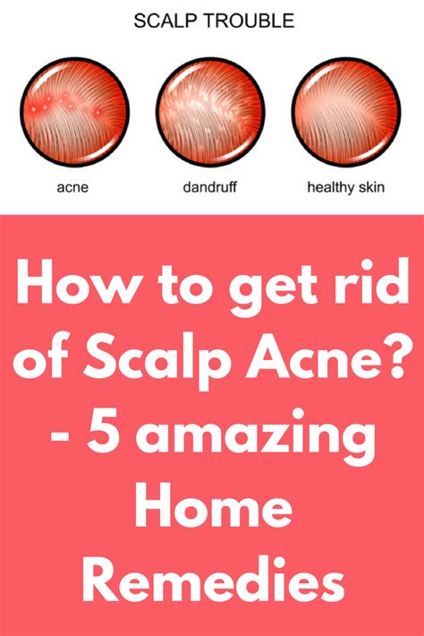 How To Get Rid Of Scalp Acne 5 Amazing Home Remedies Tired Of The