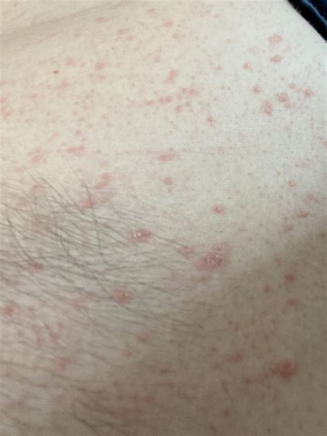 Help Identifying Rash All Over Torso And Back Does Not Itch Nor Hurt