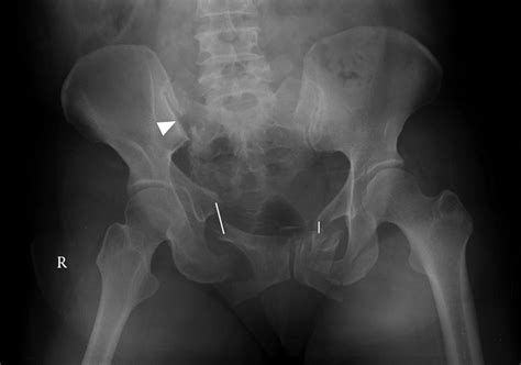 Pelvis AP X Ray Of Year Old Female White Arrow Indicates Sacral