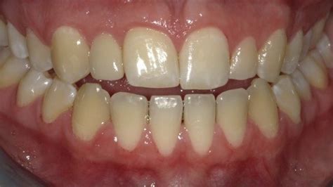 Bu işletme için google ve bing dahil 2 sosyal paylaşım sayfası, saat, telefon, web sitesi ve daha fazlasını gör. Dental Implants Westford MA | Tooth Implant | Replace ...
