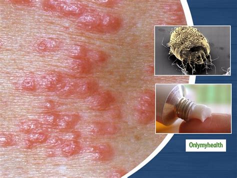 what is scabies learn about its causes symptoms and treatment onlymyhealth