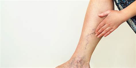 Varicose Veins Whats The Deal And How To Heal The Derm