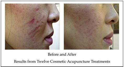 Acne Treatment And Acne Scar Treatment Brighton Cosmetic Acupuncture