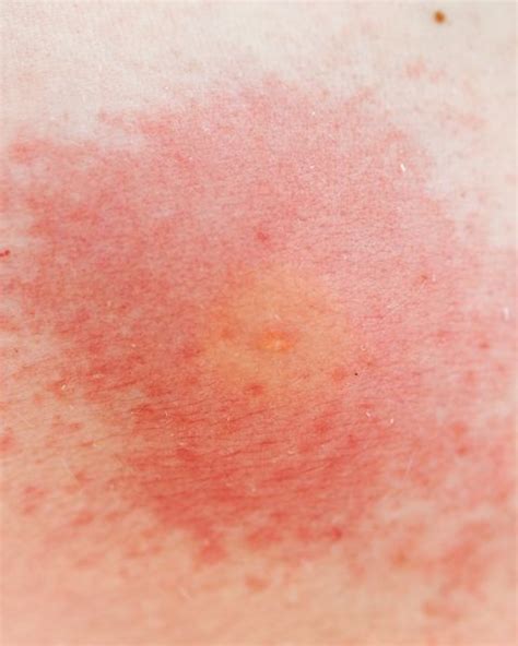 11 Common Bug Bite Pictures How To Id Insect Bites And Stings