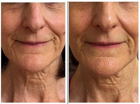 microcurrent facial before and after photos 2 facelift info prices photos reviews qanda