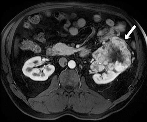 Advanced Renal Cell Carcinoma Role Of The Radiologist In The Era Of