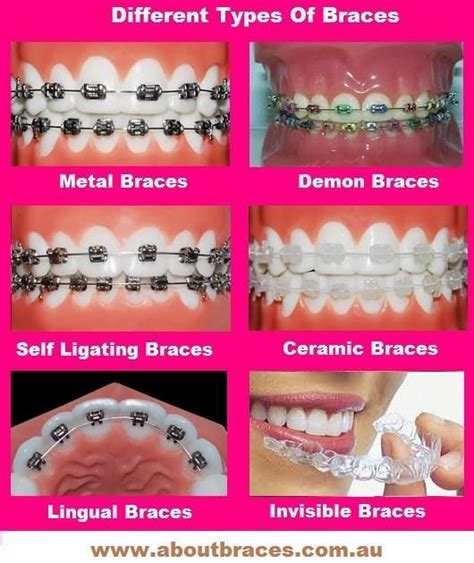 Different Types Of Braces Philbin Reinheimer Orthodontics In